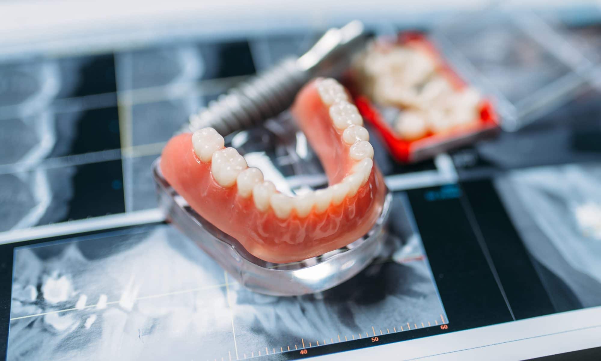 Cosmetic Dentist: What Type of Denture is The Best?