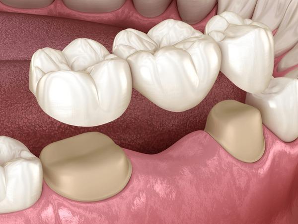 Dental Bridges Myths